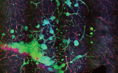 Modeling Human Brain Tumors & Investigating Mechanisms of Tumor Progression